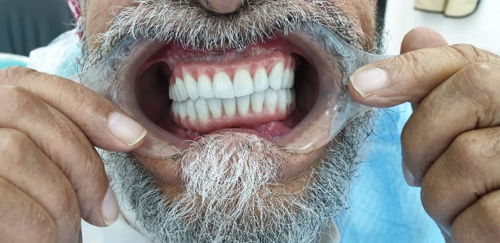 Complete smile restoration