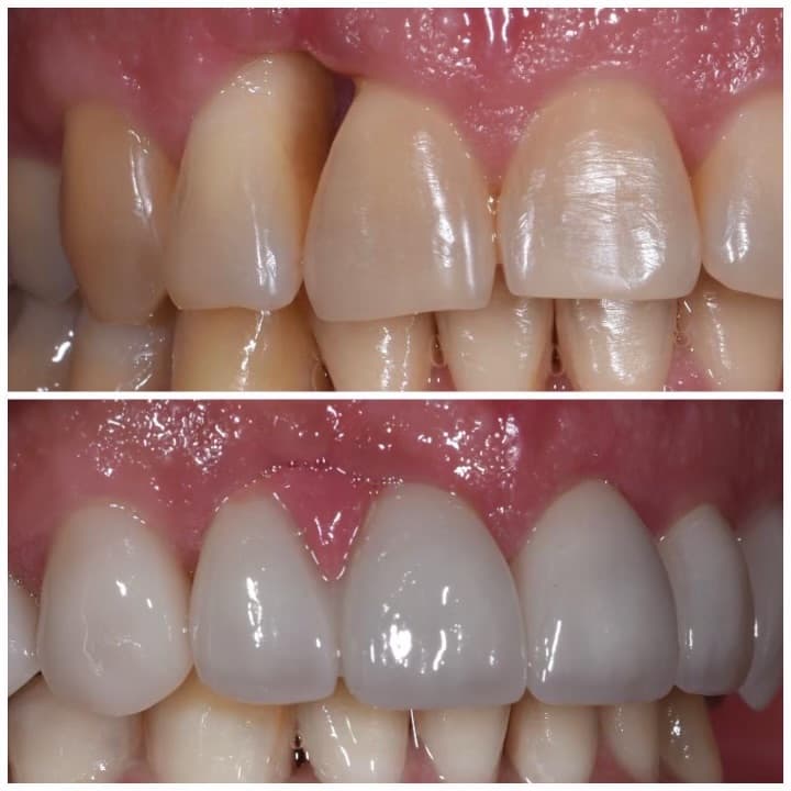 Anterior shade transformation
