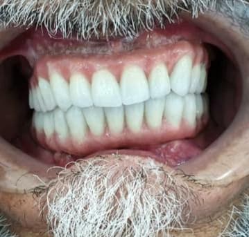 Natural full-arch finish