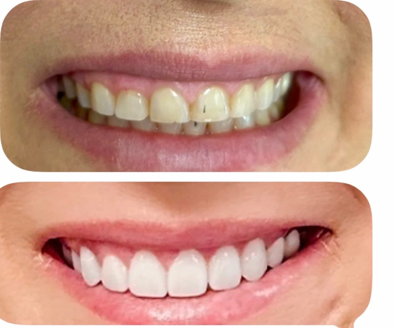 Smile design comparison