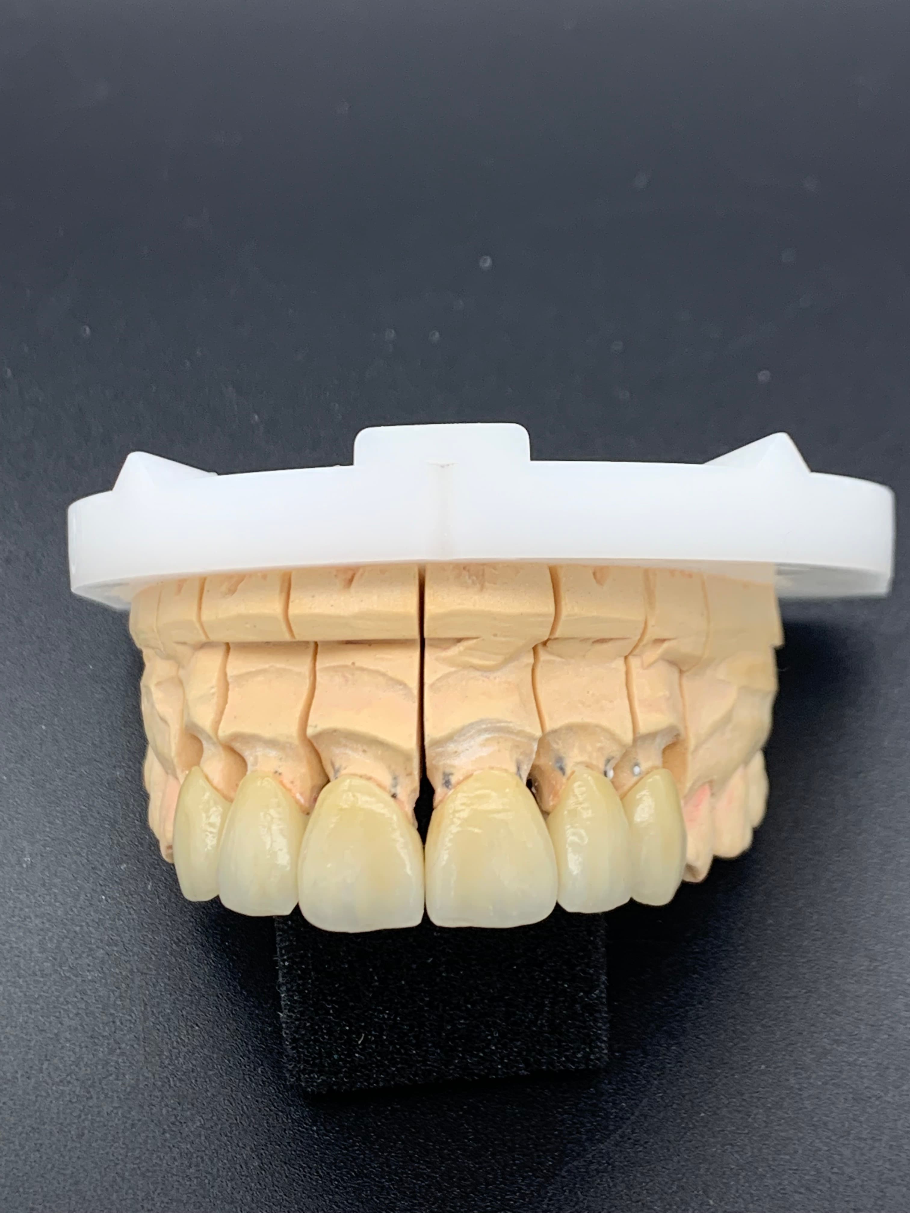 Model-based anterior work